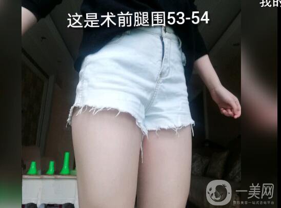 大腿環(huán)吸抽脂