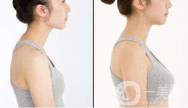 自體脂肪移植隆胸