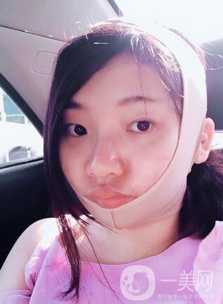 等離子光纖溶脂