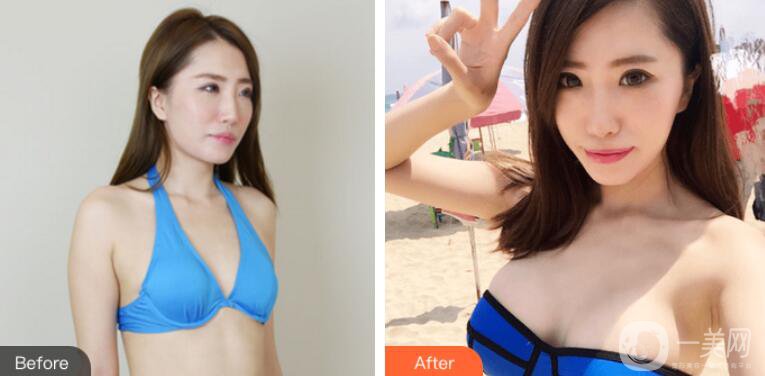 上海華美李健隆胸案例