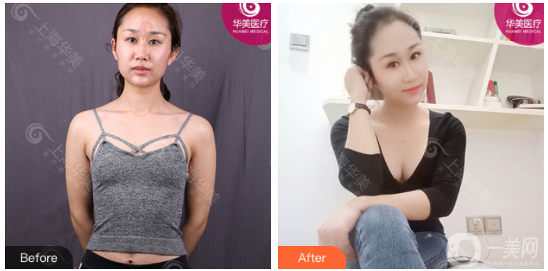 上海華美謝衛(wèi)國隆胸案例