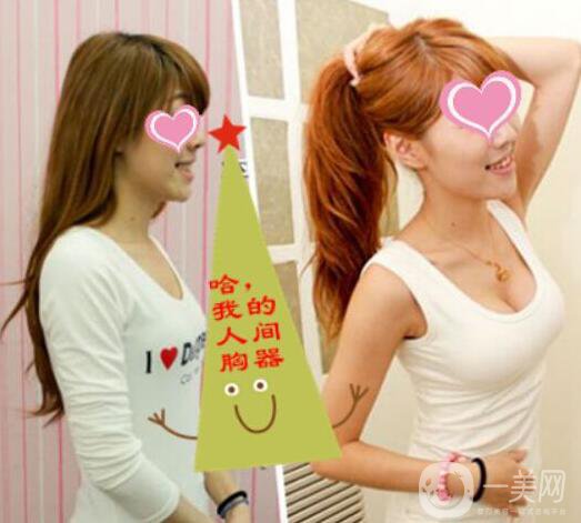 上海玫瑰院長(zhǎng)李鴻君隆胸案例