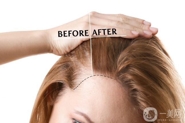 瀘州毛發(fā)移植價(jià)格是多少錢(qián)