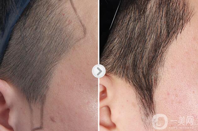 瀘州毛發(fā)移植價(jià)格是多少錢(qián)