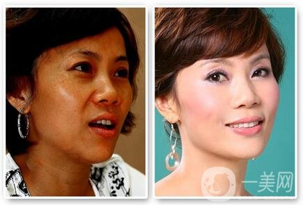 彩光嫩膚*嗎？對(duì)人體有害嗎？