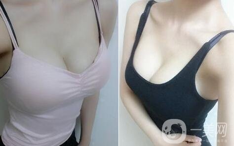 假體隆胸術(shù)有哪些特點(diǎn)？