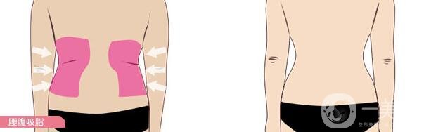 腰部吸脂的費用是多少?
