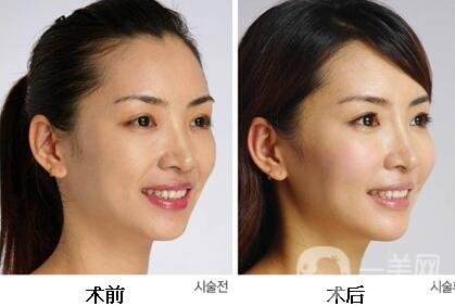 鐳射美膚副作用有哪些？