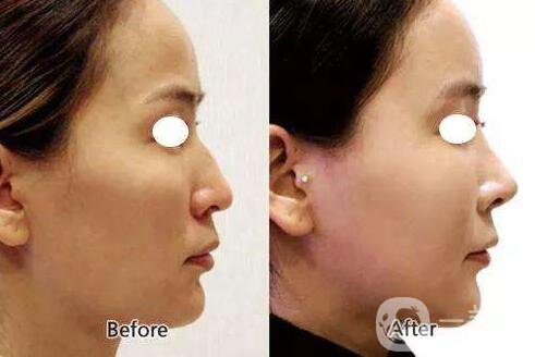 瑞蘭玻尿酸隆鼻價(jià)格多少錢(qián)？貴嗎？