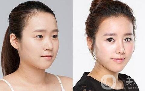 北京隆鼻價格大概是多少錢?