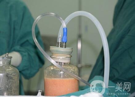 負壓吸脂*果和水動力一樣嗎?哪個更好?