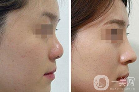 隆高鼻梁會不會肉不夠?醫(yī)生是怎么做的?