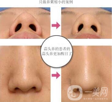 鼻翼縮小手術恢復過程