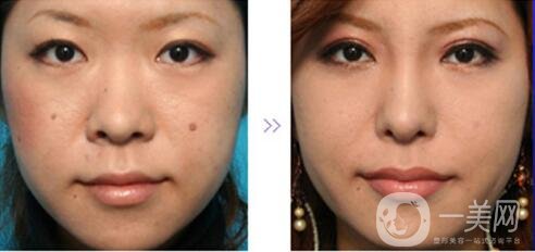 鼻翼縮小手術恢復過程