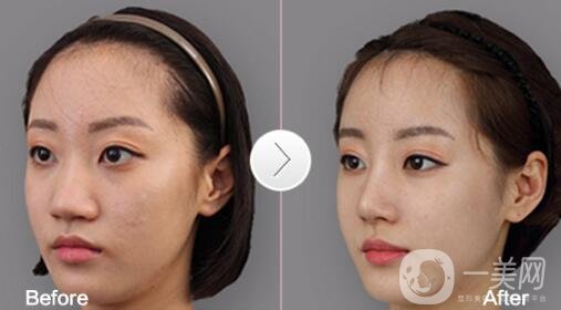 鼻翼縮小手術恢復過程