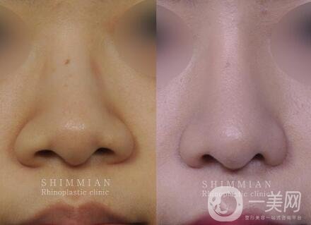 鼻翼縮小手術恢復過程