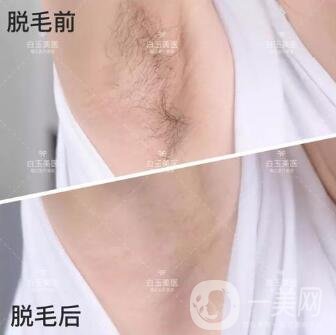 激光脫毛手術(shù)要多少錢一次？