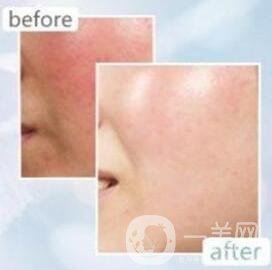 光子去紅血絲多久見*?恢復過程是怎樣的?