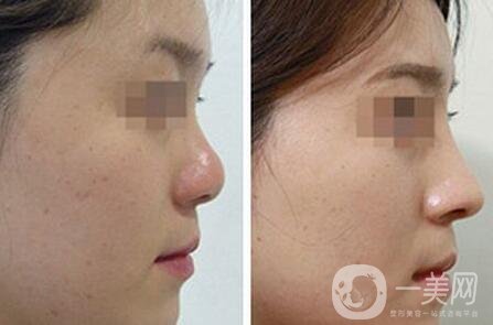 隆鼻手術(shù)疼嗎?怎么減輕疼痛感?