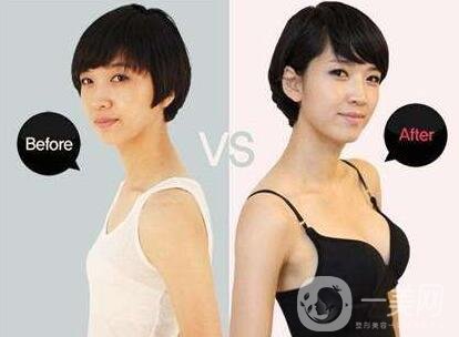 麥格假體隆胸多少錢?費用貴嗎?