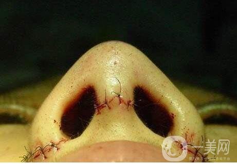 內(nèi)切鼻翼縮小多久才能恢復(fù)？是否會(huì)留下疤痕？