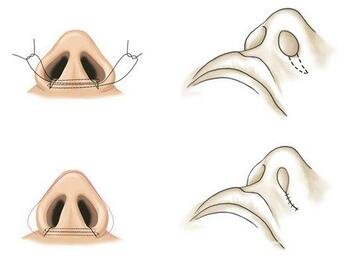 內(nèi)切鼻翼縮小多久才能恢復(fù)？是否會(huì)留下疤痕？