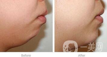 硅膠墊下巴排異癥狀有哪些？怎樣才知道排異了？