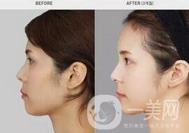 硅膠墊下巴要疼幾天？如何緩解這種疼痛感？