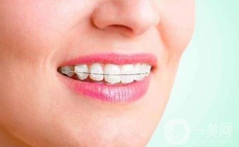 3m半隱形牙套價(jià)格多少錢?貴嗎?