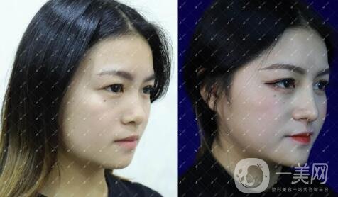 鼻整形修復手術