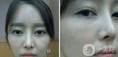 鼻整形修復手術