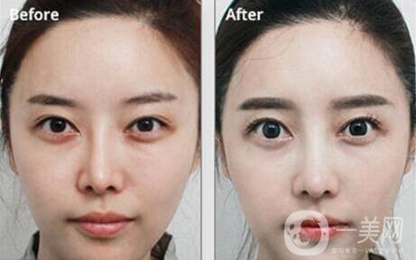 鼻整形修復手術