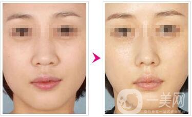 鼻翼縮小術(shù)