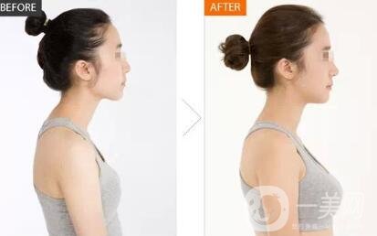 隆胸假體取出有沒有后遺癥？要怎么護(hù)理？