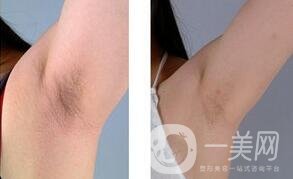 蜜蠟脫毛會(huì)越來越粗嗎？