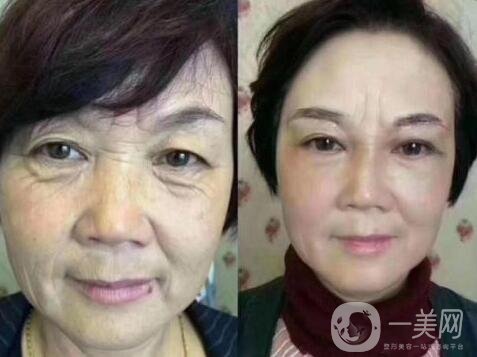 激光除皺會(huì)傷害皮膚嗎?副作用有哪些?