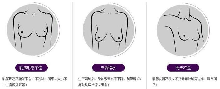 假體隆胸具體有哪些方法?材料不同方法不同?