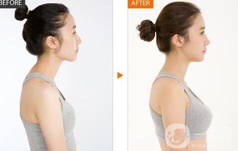 假體隆胸有哪些優(yōu)勢和缺點?為小白詳細(xì)解說