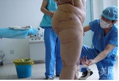 大腿抽脂多久恢復(fù)正常?恢復(fù)階段變化解說(shuō)