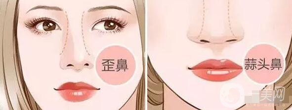 假體隆鼻的前后照片 這差距也太大了吧~