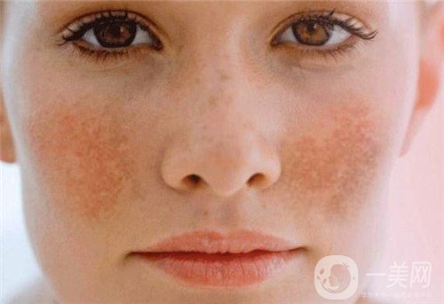 激光去雀斑會反彈嗎?術(shù)后注意事項(xiàng)有哪些?