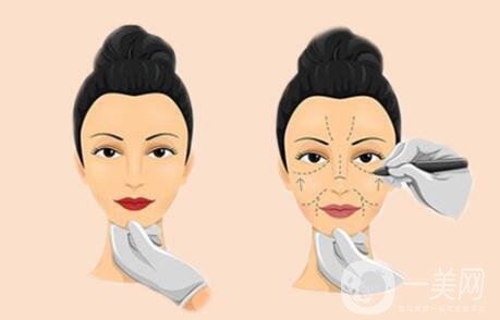 自體脂肪豐太陽穴