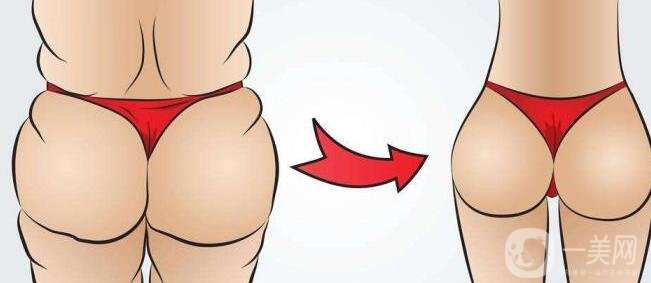 吸脂瘦臀之后幾天可以走動(dòng)?