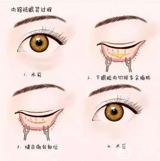 去眼袋,手術,價格,是多少,與哪些因素有關,