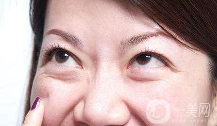 去眼袋,手術,價格,是多少,與哪些因素有關,