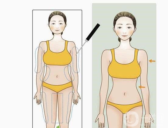 全身吸脂減肥好多錢？手術(shù)價(jià)格多少？