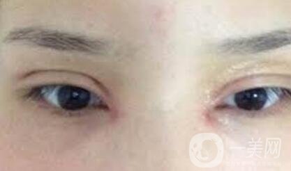 開眼角疤痕增生