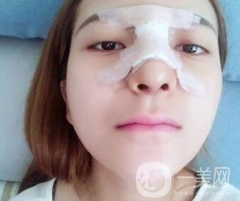 隆鼻固定膠帶幾天去掉？術(shù)后6天去掉會(huì)不會(huì)太早？