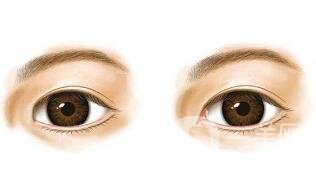 開眼角要多少錢？單獨開眼角價格貴不貴？