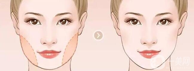 寬下頜角整形手術(shù)原來是這樣做的!【解析】